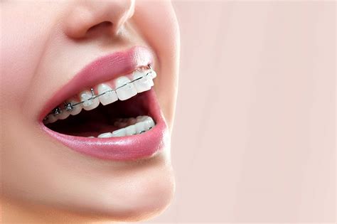 From Ordinary to Extraordinary: How Teeth Braces Can Give You a Magical Smile